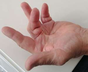 Контрактура Дюпюитрена 3 пальца левой кисти третьей степени